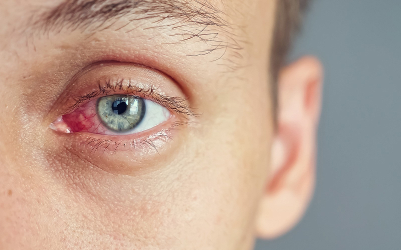 Göz Kanlanması Neden Olur?