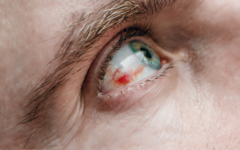 Kornea ve Hastalıkları