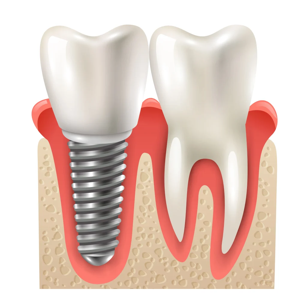 implant tedavisini devlet karşılıyor mu
