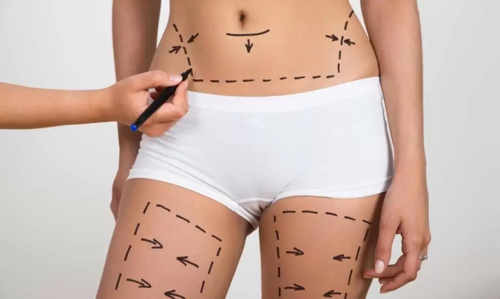 Liposuction (Yağ Aldırma) Ameliyatı