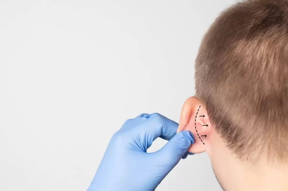 Kepçe Kulak Ameliyatı (Otoplasti)